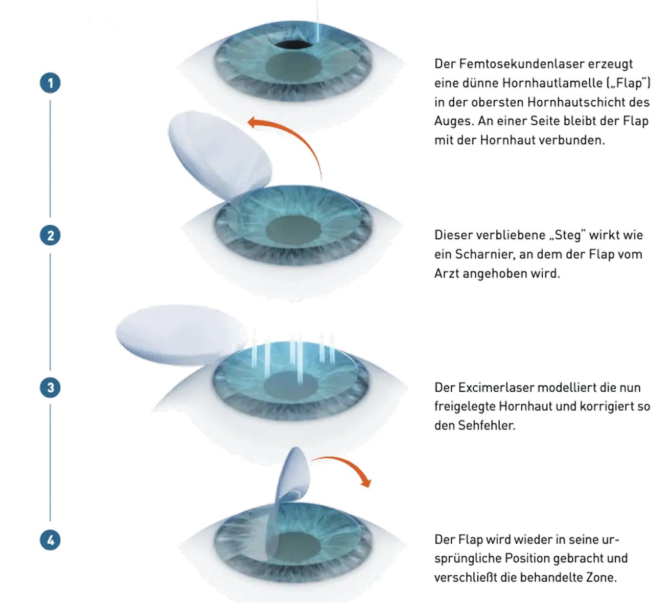 Ablauf SmartLASIK Schritt für Schritt